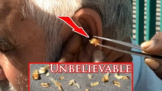 Extremely Blocked Largest Chunk Of Earwax Removed  One of Our MOST DIFFICULT Earwax Removal EVER [upl. by Aniahs]