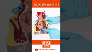 What is Fistula   Dr Biswanath Pattanaik  Reels 1 [upl. by Afrika960]