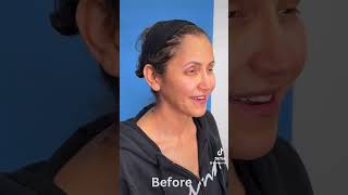 Facelift 5 days post surgery faceliftexpert cosmeticsurgery beforeandafter facelifts [upl. by Bittencourt451]