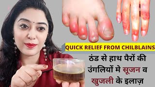 ठंड से हाथ पैरों की उंगलियों मे सूजन व खुजली के घरेलू इलाज़How to cure chilblains in hindi WINTER [upl. by Anitac22]