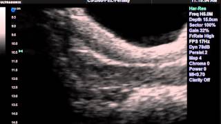 IVF Embryo transfer [upl. by Farrish]