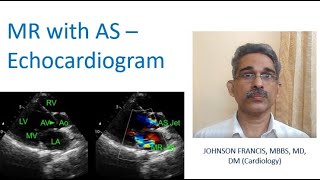 Mitral Regurgitation with Aortic Stenosis – Echocardiogram [upl. by Lamori710]