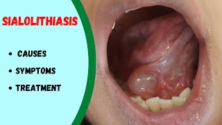 Salivary gland stone  Sialolithiasis  How to remove [upl. by Fransisco]