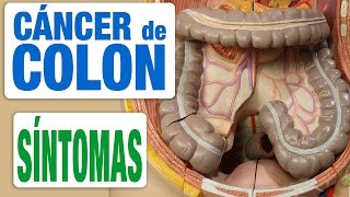 Cáncer de Colon  Síntomas [upl. by Durward46]