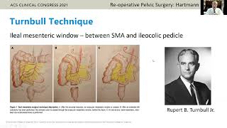 Closing Colostomy in Re Operative Pelvis in Patients Who Have Had a Hartmanns Procedure [upl. by Stilwell]