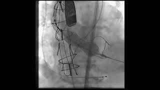 TAVR valve deployment while rapid pacing [upl. by Nwadal562]