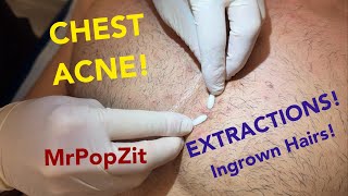 Chest congestionblackheads whiteheads ingrown hairs Multiple plugs extracted patient left happy [upl. by Bobbette]