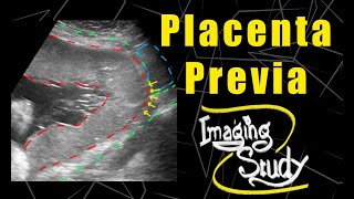 Complete Placenta Previa  Ultrasound  Case 91 [upl. by Imtiaz]