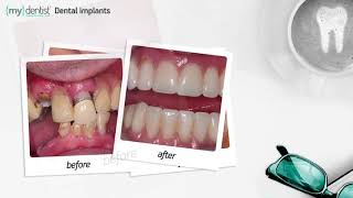 Dental implants before and after by mydentist [upl. by Publea]