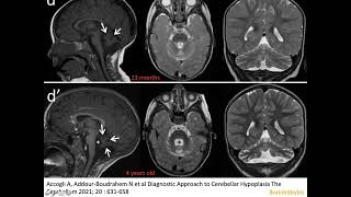 24 Pontocerebellar hypoplasia congenital cerebellar atrophy dragonfly rhombomeres neuroimaging [upl. by Irrol279]