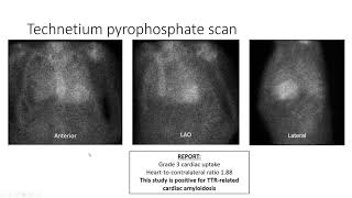 July 2020 Topics in Cardio Oncology Webinar [upl. by Timmi]