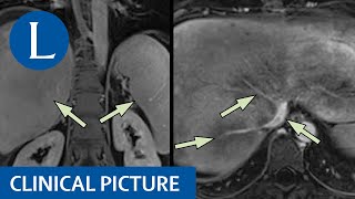 BuddChiari syndrome complicates a case of paroxysmal nocturnal haemoglobinuria [upl. by Georgeanne545]