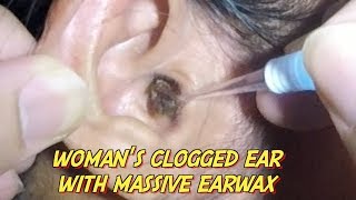 Womans Clogged Ear with Massive Earwax is Finally Removed [upl. by Eimyaj106]