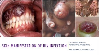 HIV associated skin manifestations HIV dermatology funny skincareeducation funny [upl. by Keeler209]