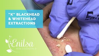 Blackheads Whiteheads Extractions on quotKquot  Part 2 [upl. by Aihseya]