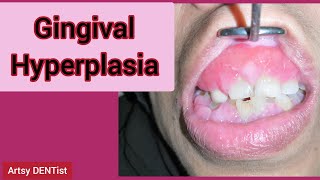 Drug Induced Gingival Hyperplasia [upl. by Eimmot]