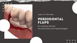 Periodontal Flaps [upl. by Annaitsirk]