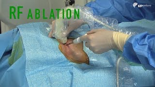 Radiofrequency Ablation [upl. by Marlo]