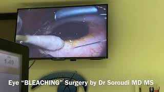 Eye Bleaching Surgery for Racial Melanosis Dr Ebbie Soroudi MD MS [upl. by Eibor]