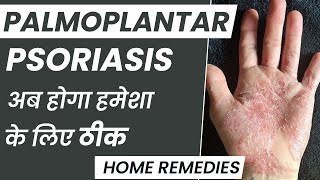 How To Control Palmoplantar Psoriasis at Home  Palmoplantar Psoriasis का इलाज कैसे करें [upl. by Yspyg]