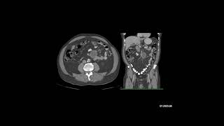 Radiology Case of the Week The most likely diagnosis in this case is [upl. by Anihpesoj772]