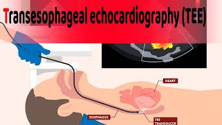 Transesophageal echocardiography TEE is a heart test understand what how amp when its doctors use [upl. by Salta704]