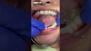 Invisalign Braces  Aligners for Teeth  Invisalign Time Lapse  invisalign invisalignsmile short [upl. by Shelbi]