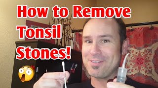 How to Easily Remove Tonsil Stones 💎💉 [upl. by Jemy]