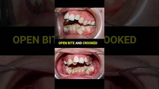 Braces super crooked and openbite teeth braces orthodontist dentist [upl. by Ellerd]