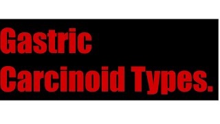 Gastric Carcinoid Types [upl. by Ijneb967]