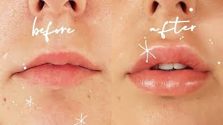 Getting Lip Injections  Before amp After VLOG [upl. by Leahci]