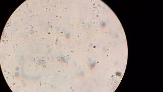 Microscopic potassium KOH preparation test Positive pattern shows fungal hyphae in skin lesions [upl. by Anatniuq275]