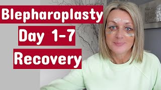 My Eye Surgery UpperampLower blepharoplasty  Day 17 Recovery [upl. by Shannon872]