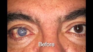 Custom Color Contacts  Prosthetic Before and Afters [upl. by Adiela]