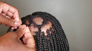 Box Braids Alopecia IGirenesbraids [upl. by Margaretha]