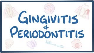 Gingivitis and periodontitis  causes symptoms diagnosis treatment pathology [upl. by Gnuhp]