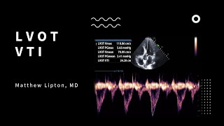 How to use the LVOT VTI to determine fluid responsiveness for the critically ill patient [upl. by Oznol]