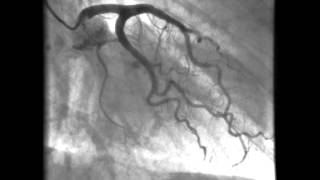 Kardiologie linkes Herzkranzgefäß  Darstellung der Kornararterien [upl. by Nahshon438]