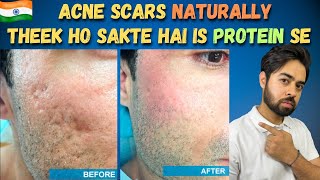 Remove Acne Scars Naturally  3 Remedies 100 Works With Results [upl. by Anibur913]