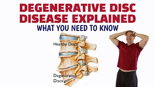 Degenerative Disc Disease Explained What You Need To Know [upl. by Ahsha]