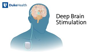 Deep Brain Stimulation DBS for Epilepsy  Duke Health [upl. by Avehsile301]