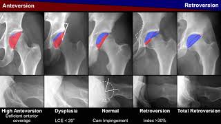 S Steppacher Pelvic incidence in acetabular retroversion Hip Symposium 2018 [upl. by Briggs]