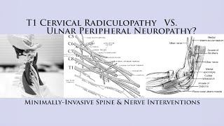 How to Differentiate T1 Cervical Radiculopathy vs Ulnar Nerve Neuropathy Cubital Tunnel Syndrome [upl. by Nady891]