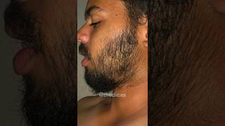 2 MESES usando MINOXIDIL evolução dos inscritos barba minoxidil [upl. by Aun56]