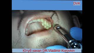 Infiltration anesthesia for treatment 26 tooth [upl. by Morganica189]