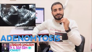 LEVEL 3  FEMALE PELVIS  GYN  Myometrial lesions  Adenomyosis [upl. by Ardisi]