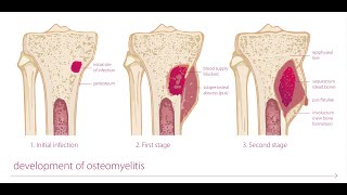 Osteomyelitis Of Bone In Hindi  part 1 [upl. by Levine865]