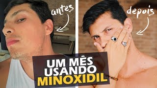 1 mês usando MINOXDIL [upl. by Aihsema]