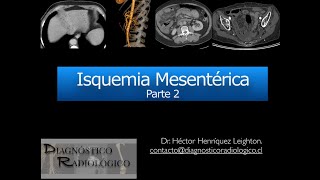 Isquemia Mesentérica Parte 2 [upl. by Llenrub]