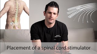 Spinal Cord Stimulator Placement [upl. by Neumark624]